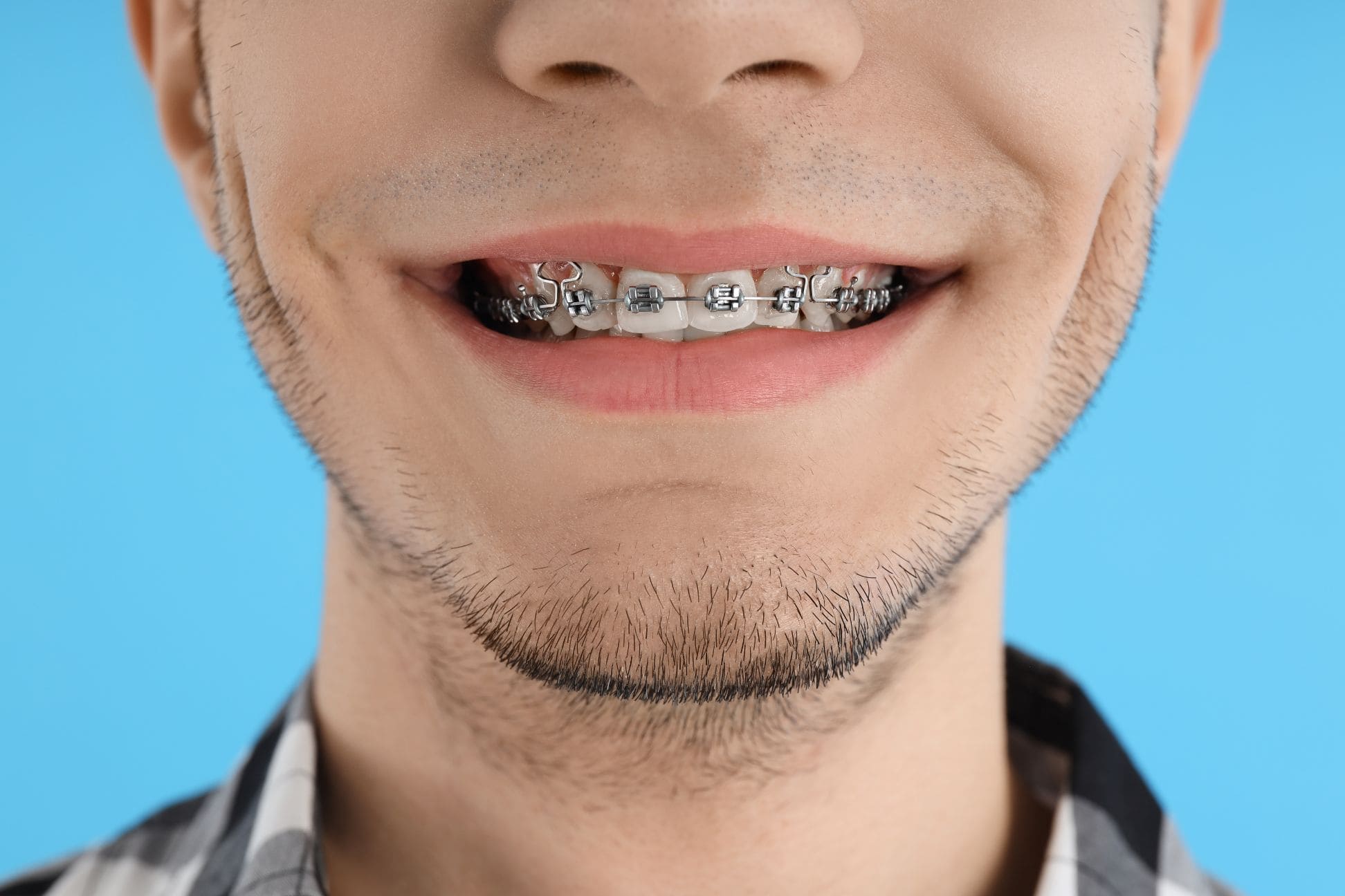 Ceramic Braces in Midland TX - Clear Bracket Braces