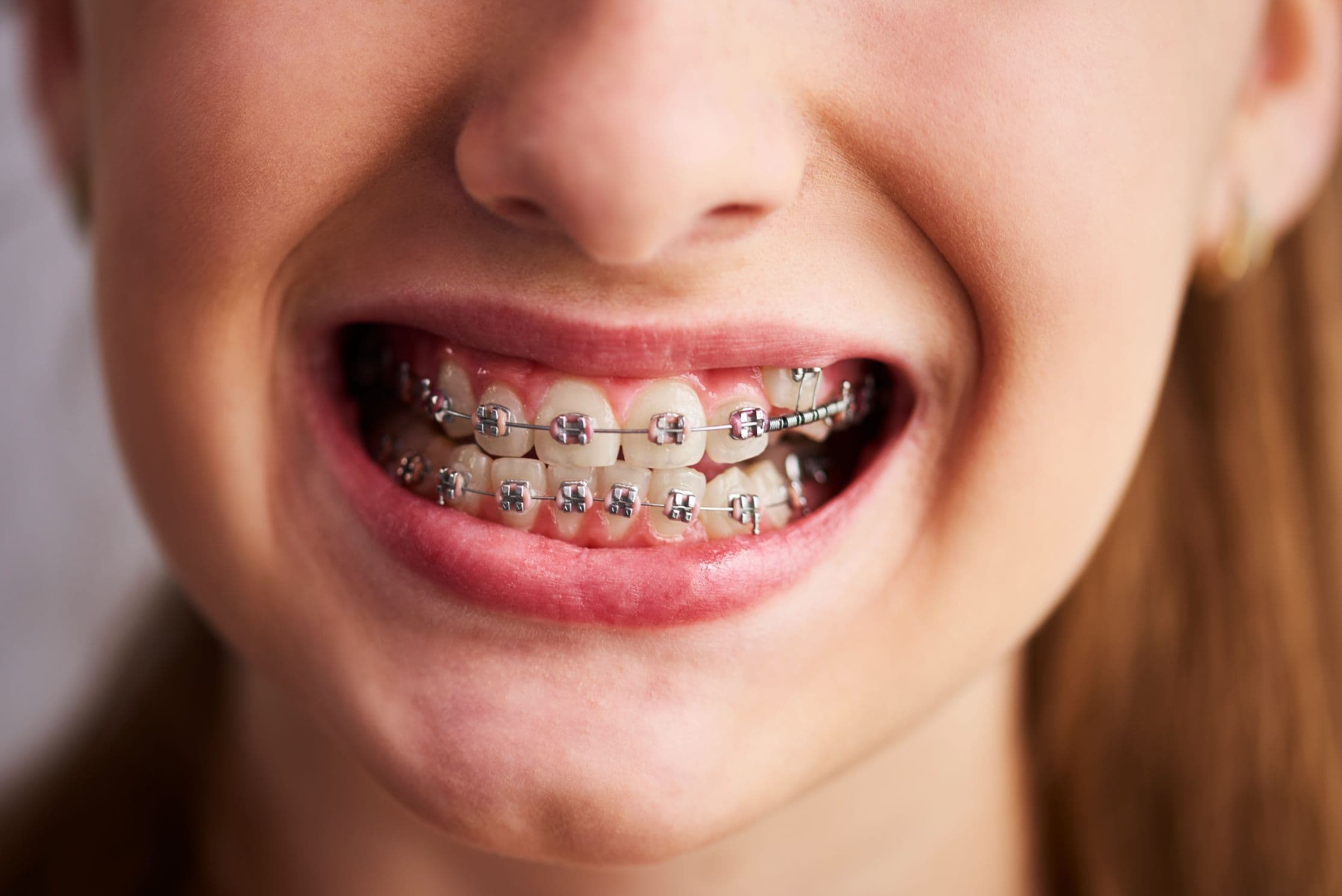 Braces In Plainview, TX