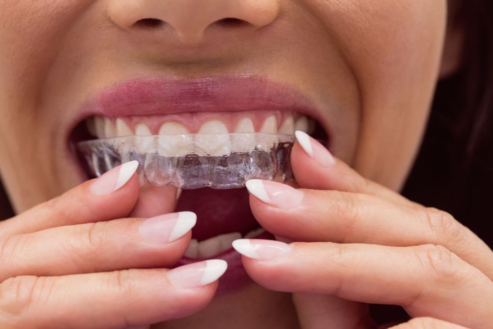 Invisalign Provider In Hobbs, NM