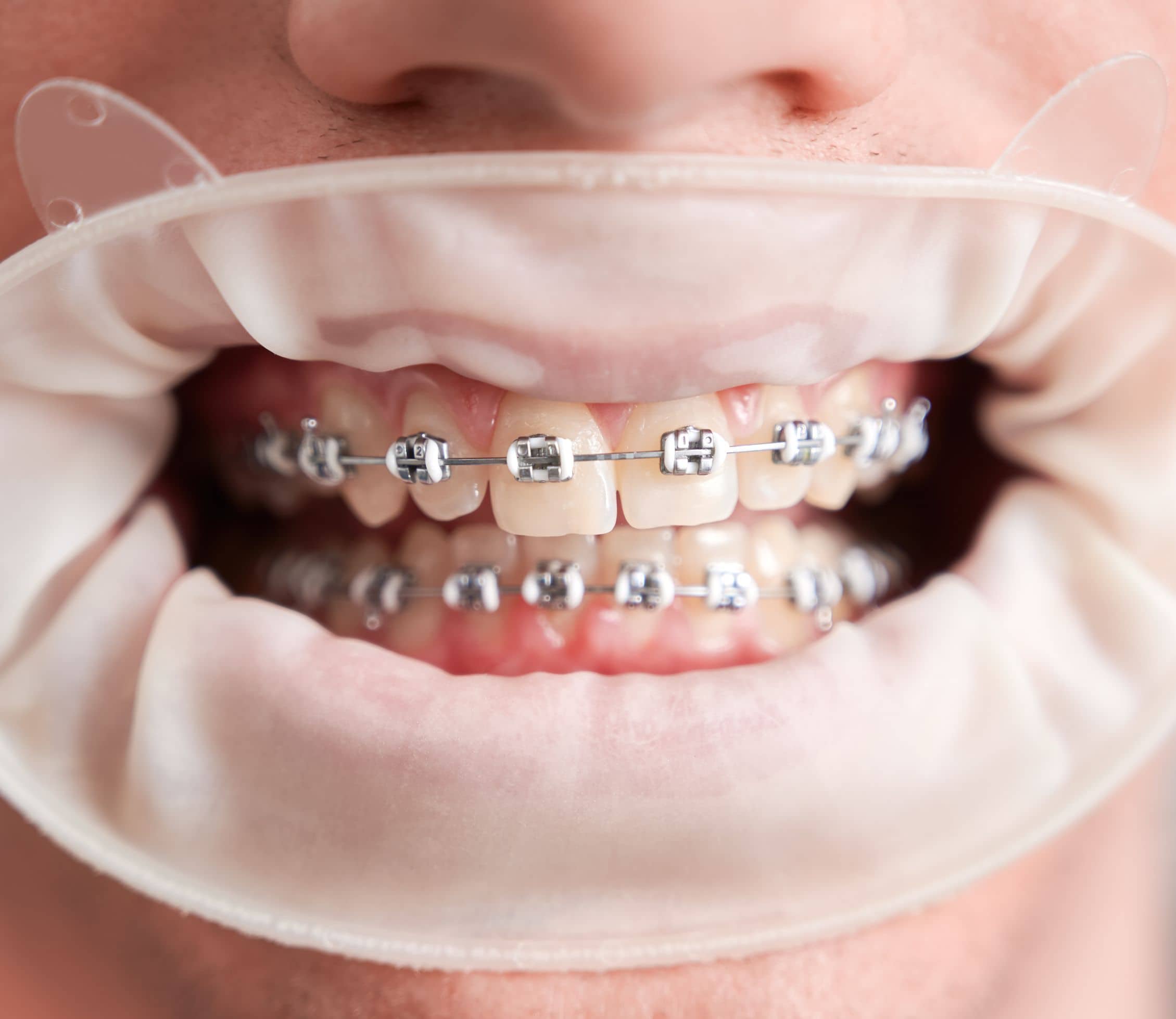 Ceramic Braces in Midland TX - Clear Bracket Braces